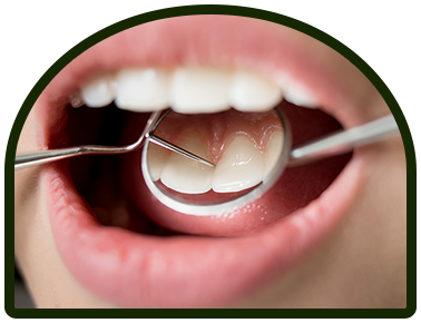 pollard-arch-fillings
