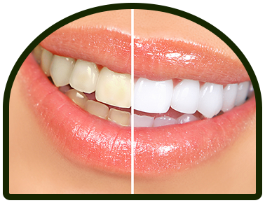 pollard-arch-whitening