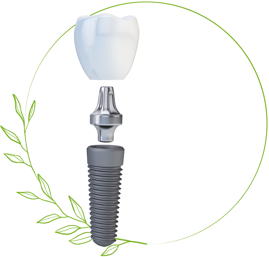 3 parts of dental implant