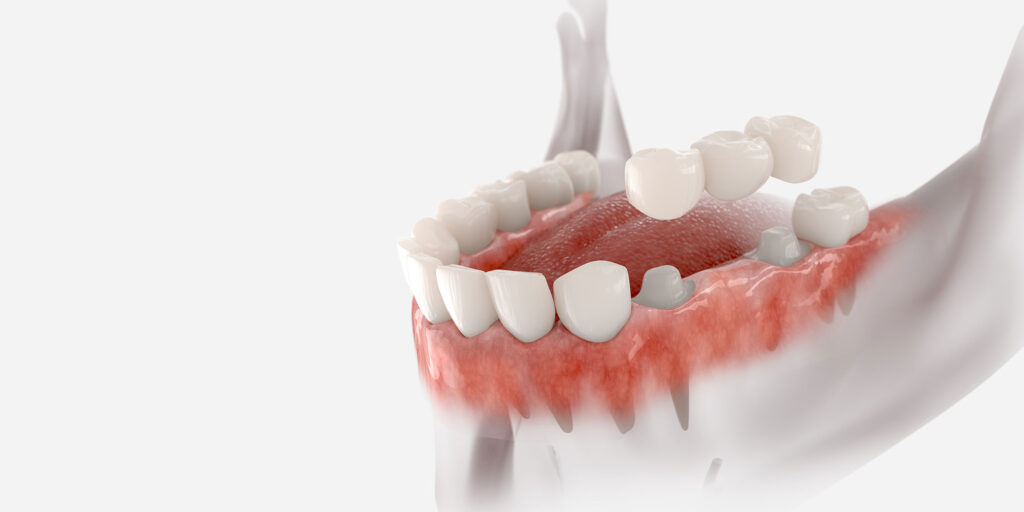 dental bridge