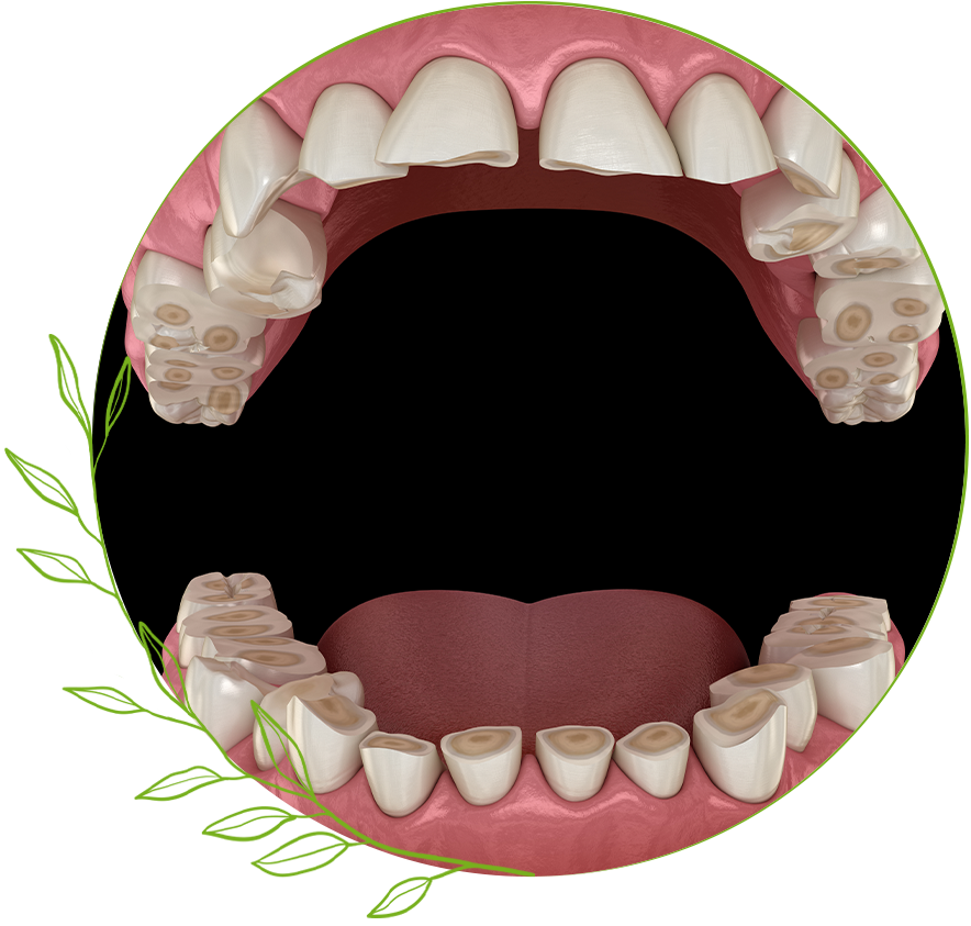 Bruxism
