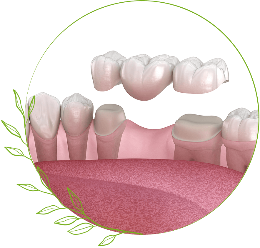 Dental Bridge