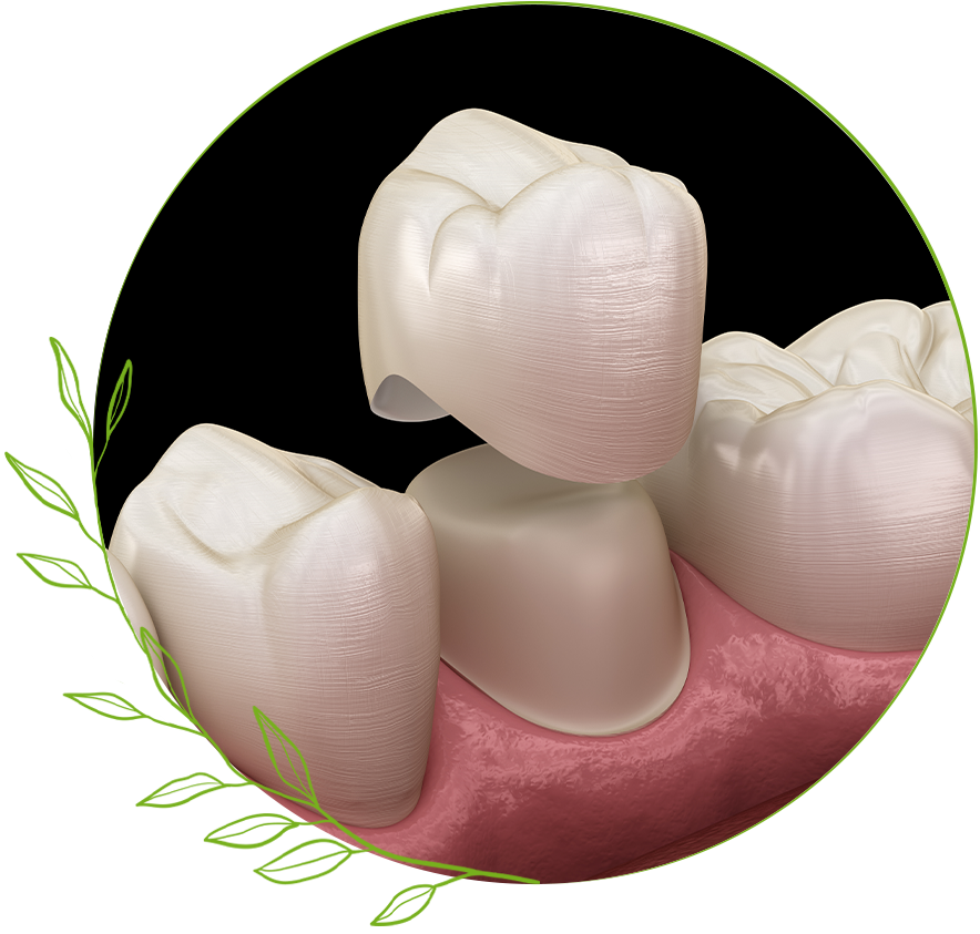 Dental Crown