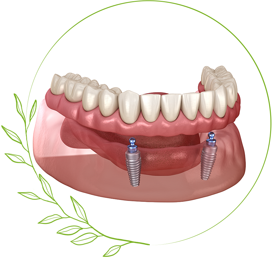 denture supported implants