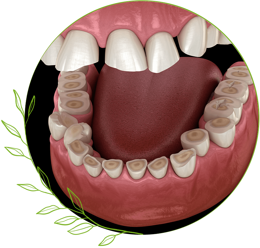 Bruxism
