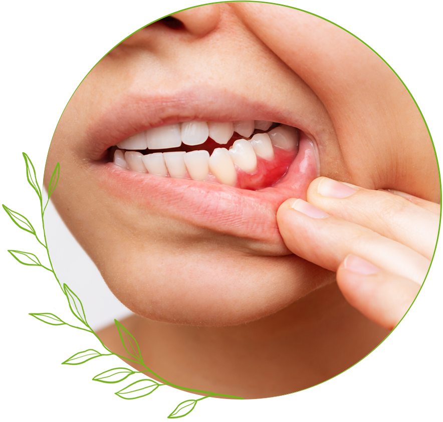Gum Disease
