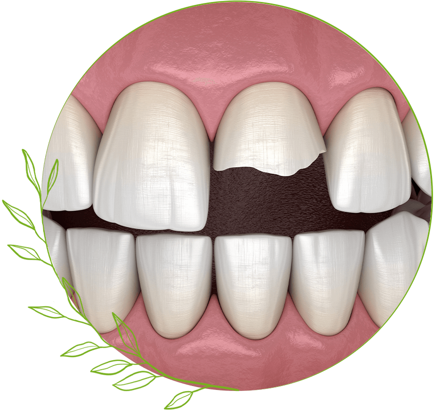 Cracked tooth