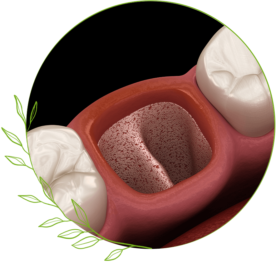 Tooth-abscess