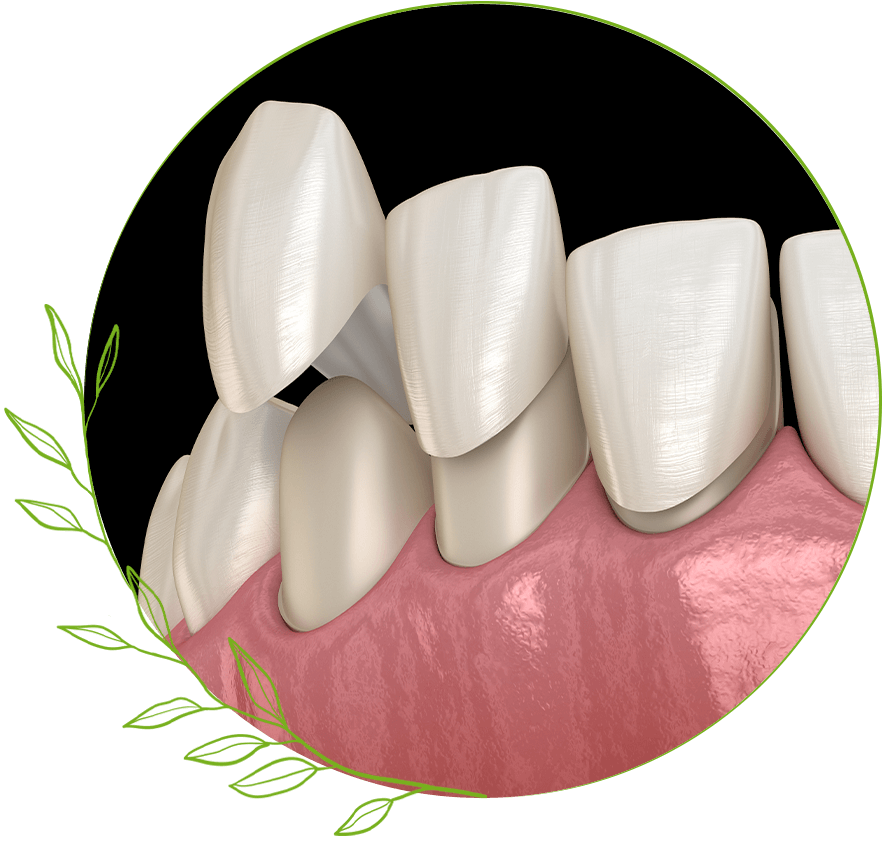 Veneers