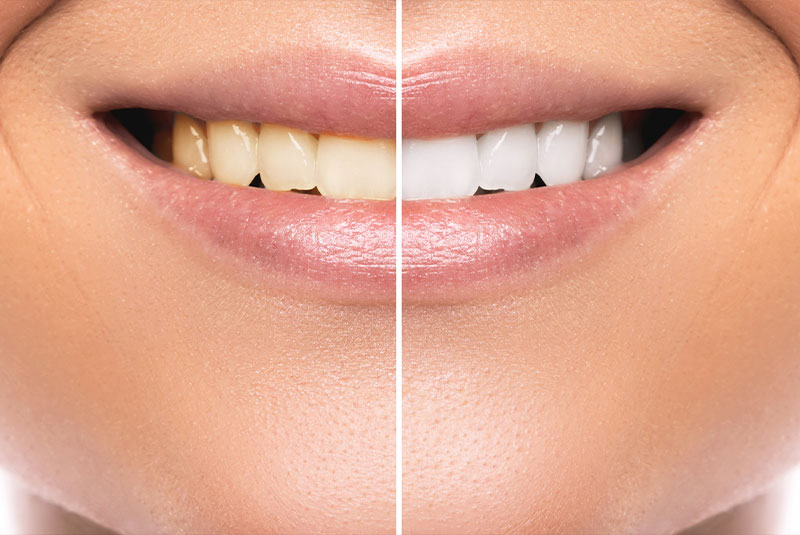 before and after of Teeth whitening