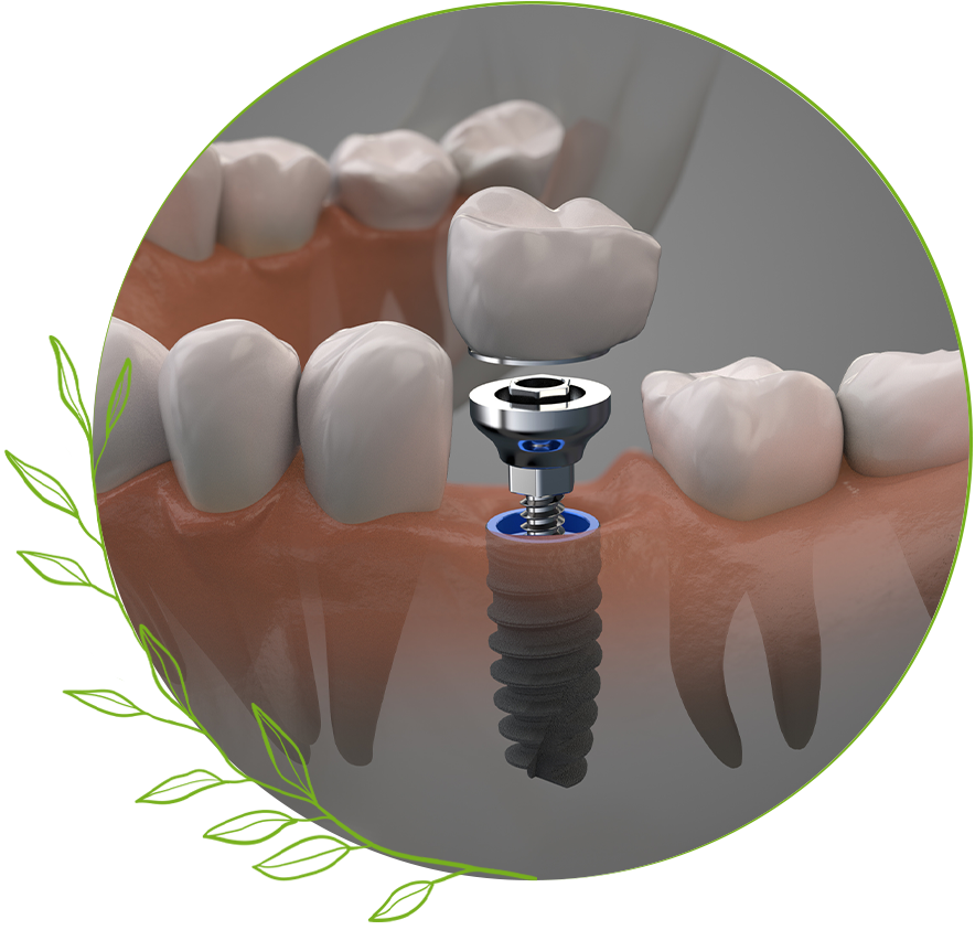 dental implants