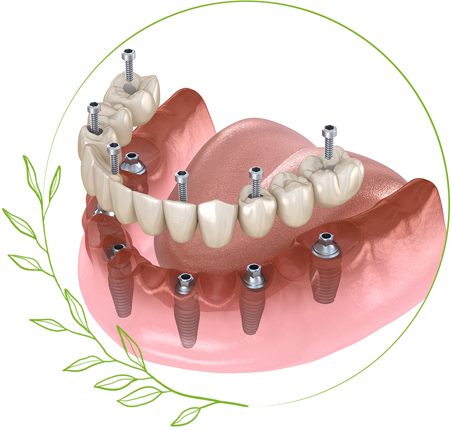 full mouth implants