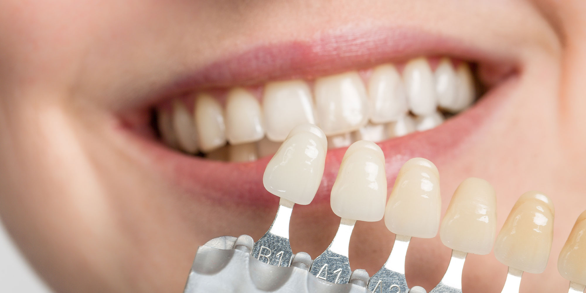 veneers