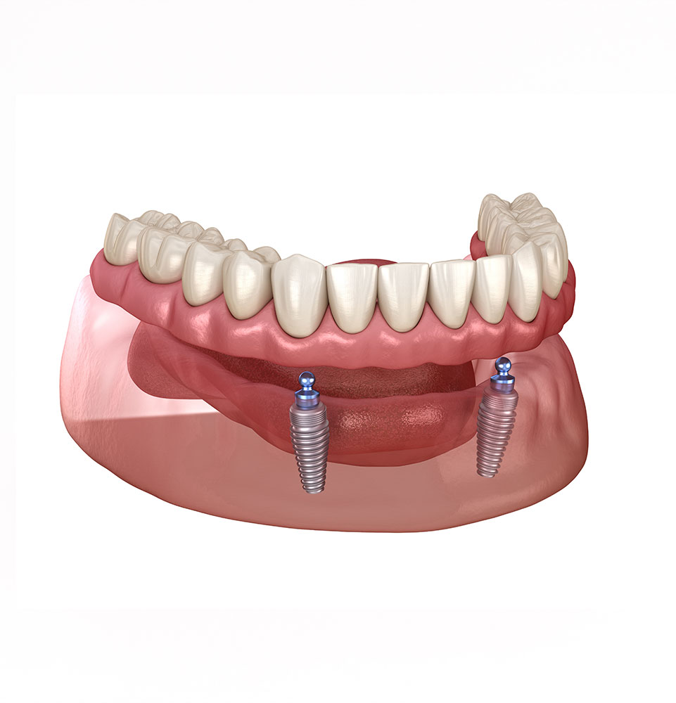 Implant Supported Dentures