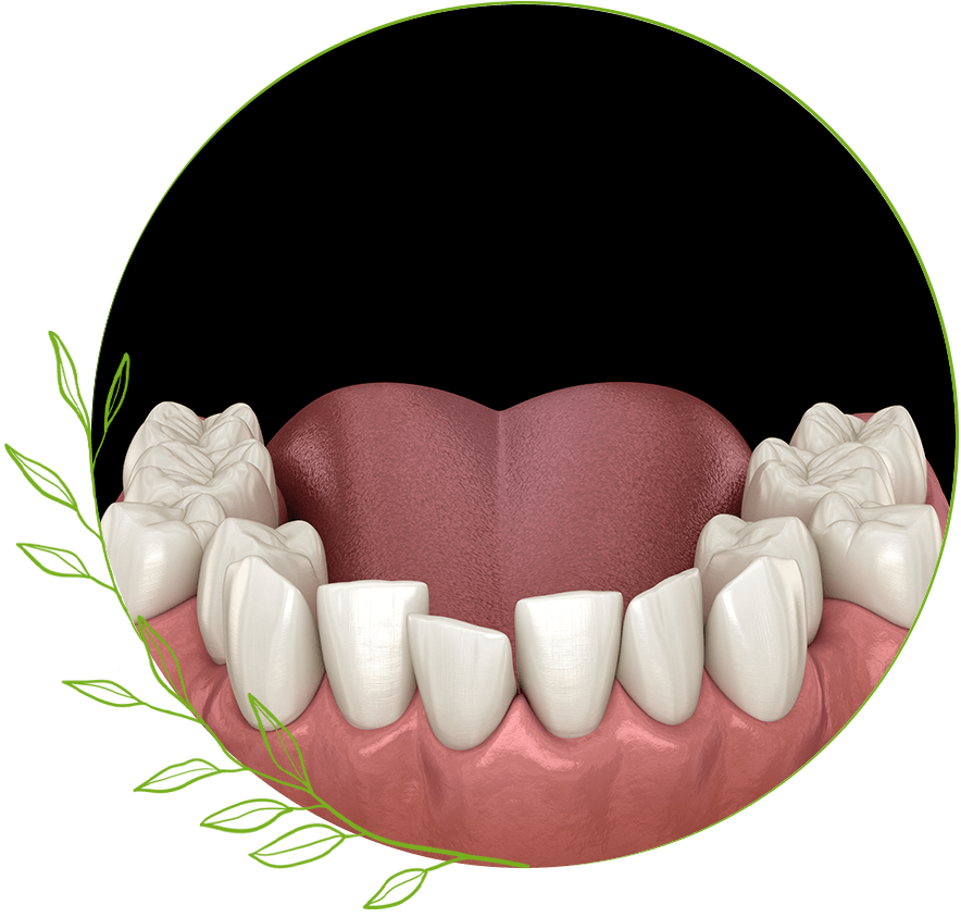 Uneven teeth